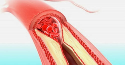 تقنية حديثة لعلاج تمدد الشرايين... بلا تدخل جراحي