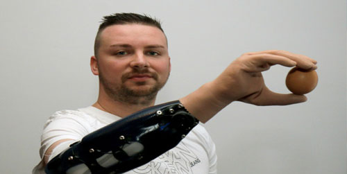 3 Austrians Get Bionic Hands After Amputation