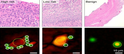 Smartphone holograms can diagnose cervical cancer