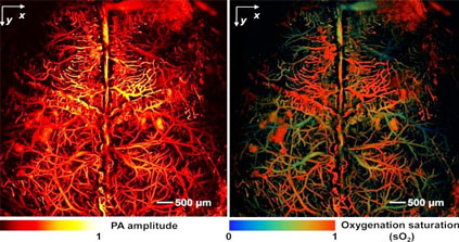 Une nouvelle imagerie médicale combine laser et ultrasons