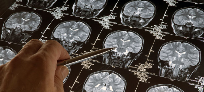 تطوير الذكاء الاصطناعي لتشخيص سرطان الدماغ